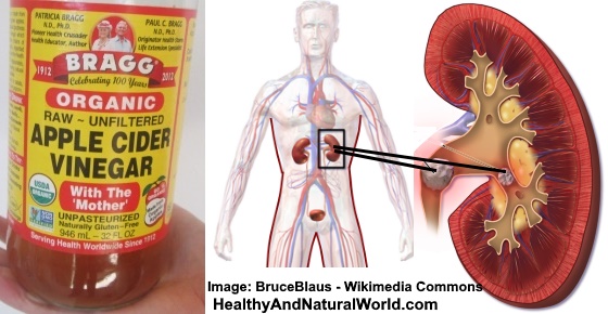does vinegar help kidney stones