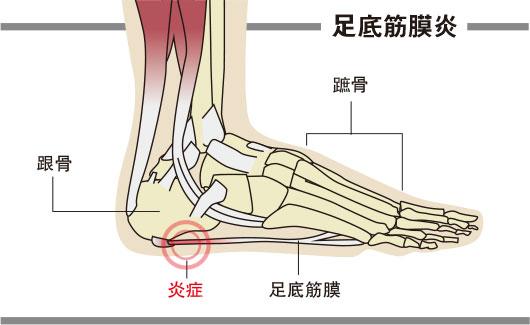 静脉曲张夹击足底筋膜炎更难治 Nestia