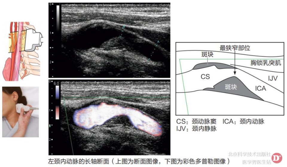 颈内动脉狭窄的超声诊断 一文掌握 Nestia