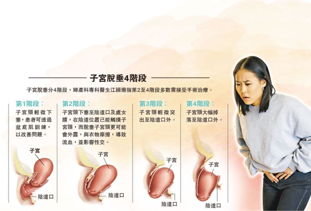 女性健康 不是产妇独有子宫膀胱脱垂非尿频元兇 Nestia