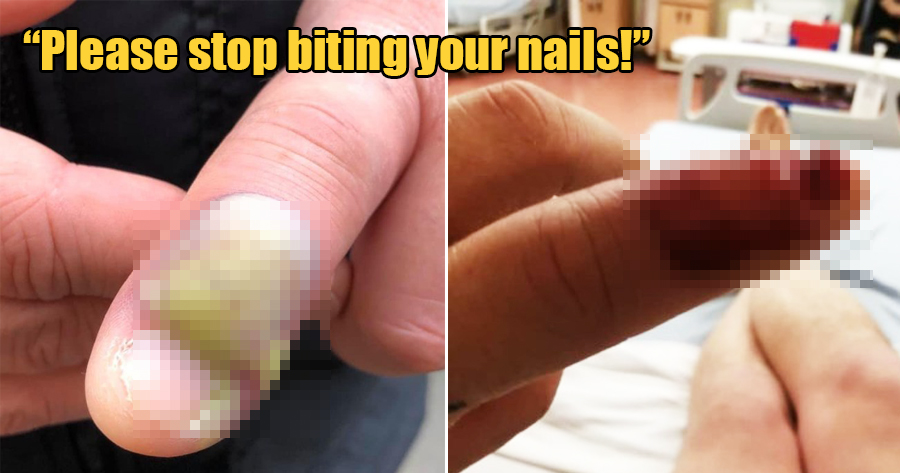 Woman Shares How You Could Develop An Infection If You Bite Your Nails Too  Much | Nestia