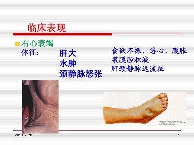 腿肿 一按一个坑 是什么病 医生告诉您 常见的就是心肾衰竭 Nestia