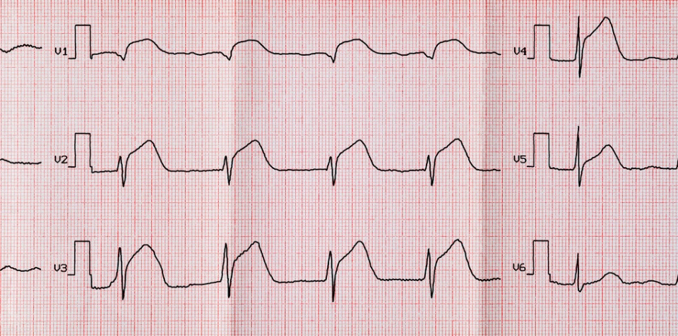 这样的心电图提示心脏最大血管堵塞 九死一生 Nestia
