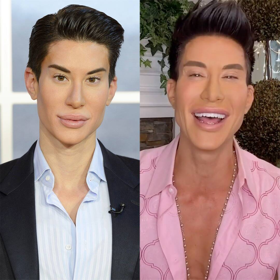 Human Ken Doll Is Back Hear All About His 900 Cosmetic Surgeries In