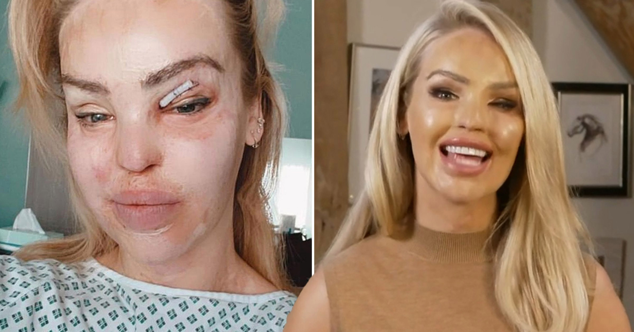 Katie Piper reveals bandaged eye in hospital as she recovers from