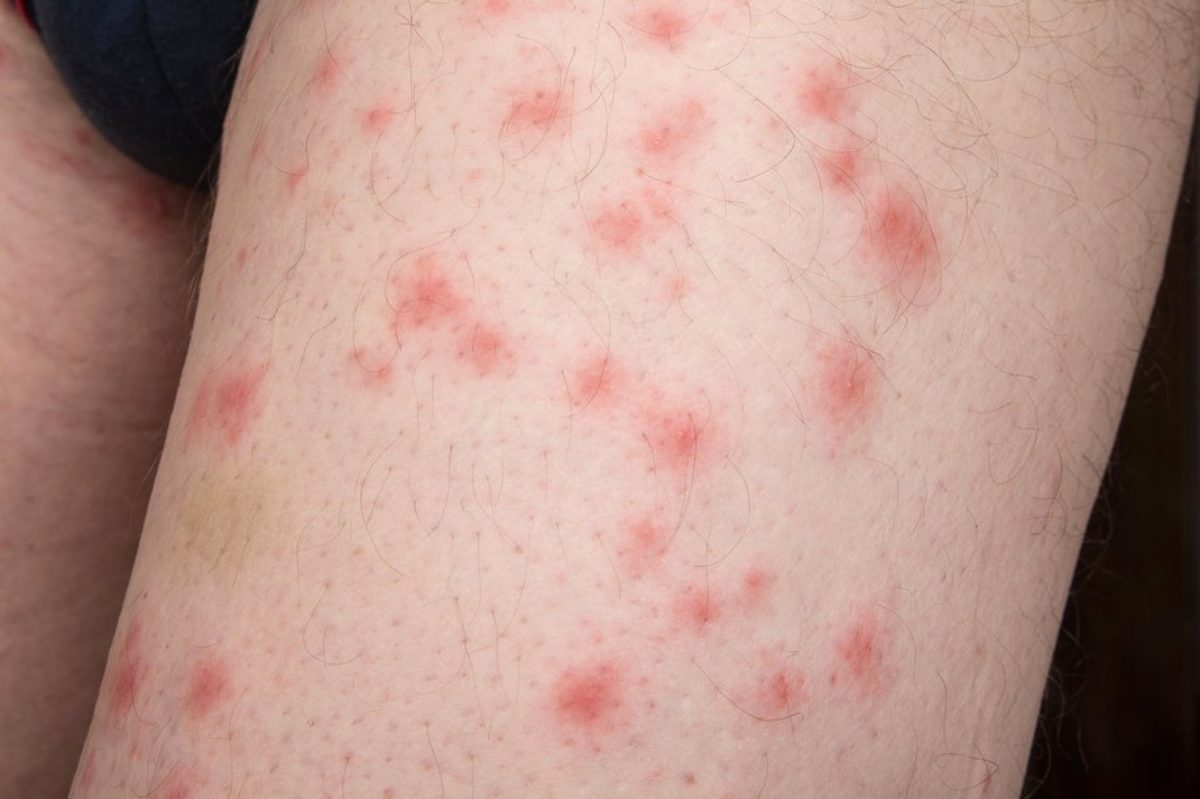 how-to-identify-various-bug-bites-the-different-ways-your-skin-reacts