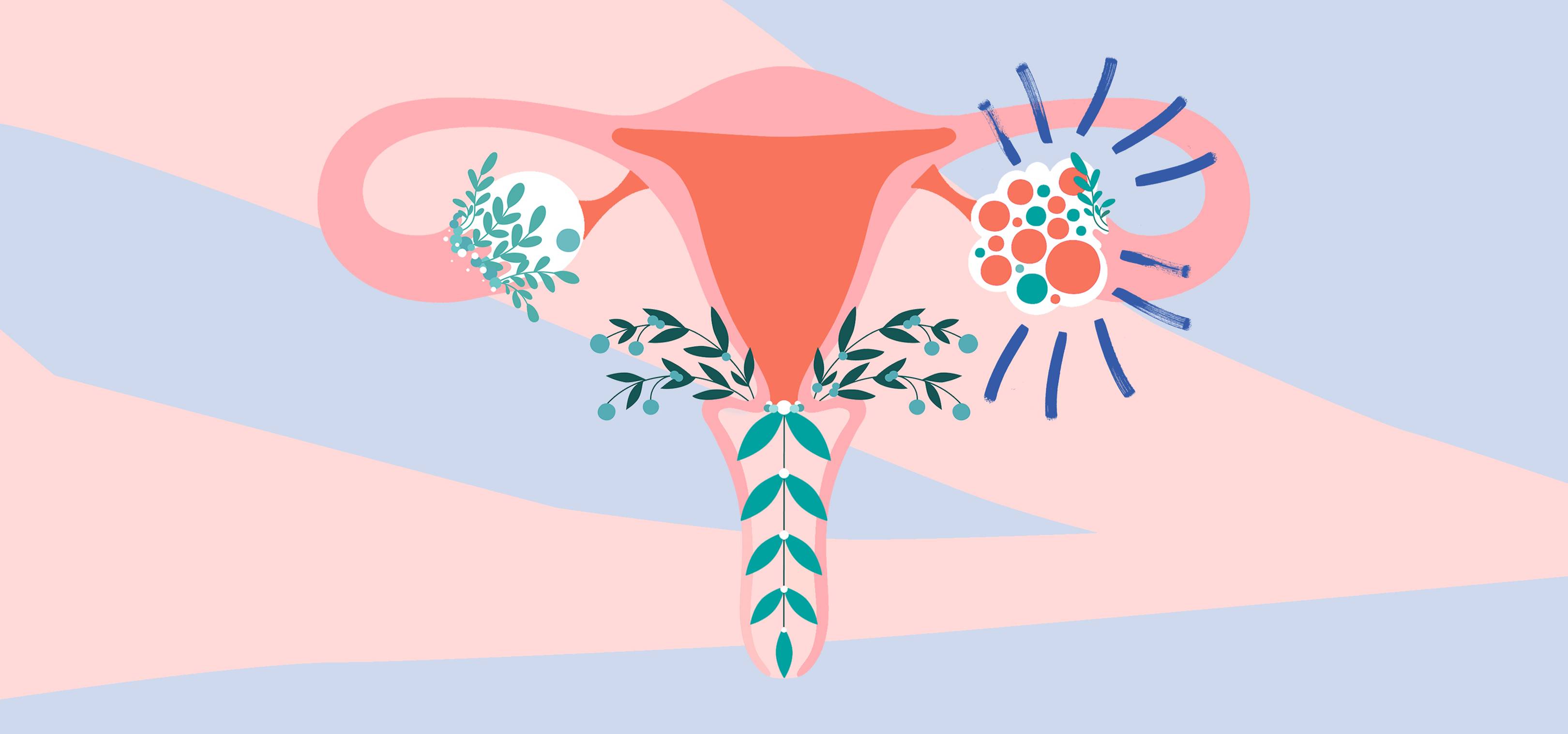 Everything You Need To Know About Polycystic Ovary Syndrome Including 