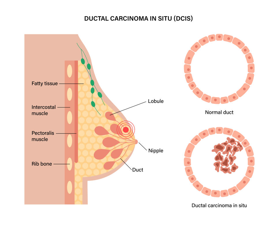 the-different-types-of-breast-cancers-as-dear-deidre-sanders-shares