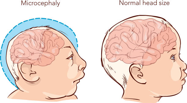 Patau Syndrome Causes Symptoms And Life Expectancy Of Diagnosed   647a1e523914c956466379bc955c3266 